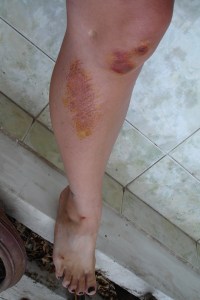 Motorbike Accidents in Ho Chi Minh City